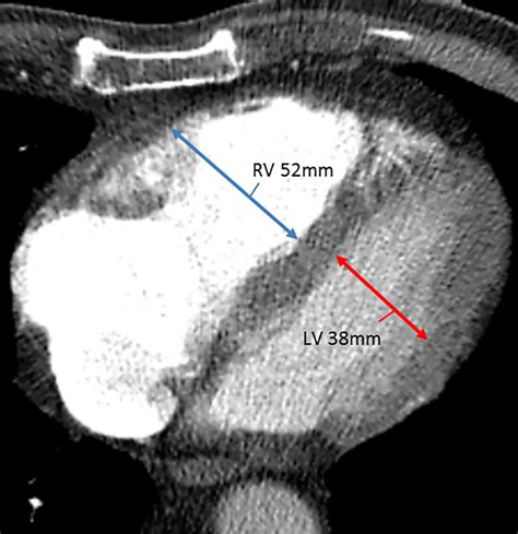 rv lv ratio pulmonary embolism|right ventricular to left lv ratio.